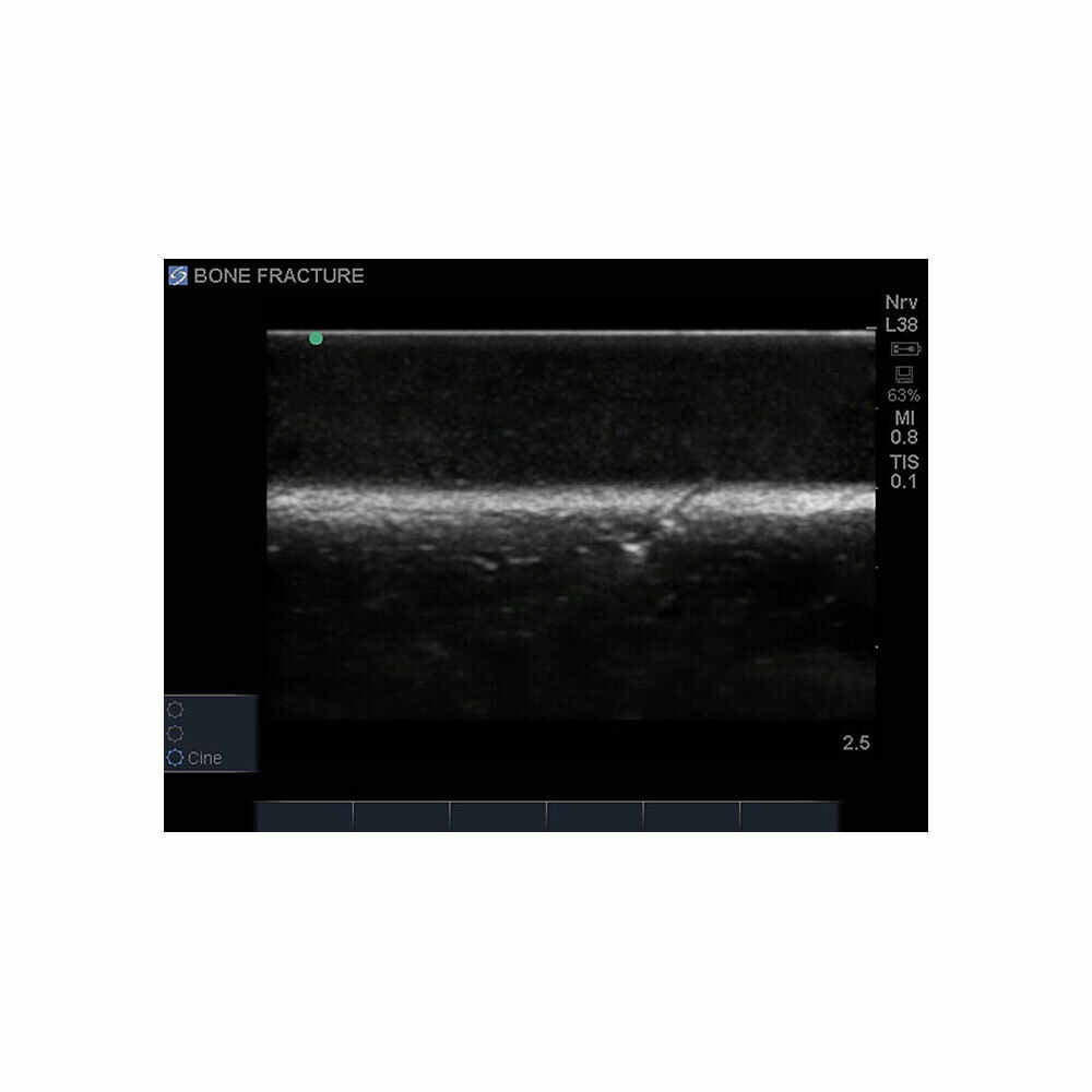 Blue Phantom Bone Fracture Ultrasound Training Block