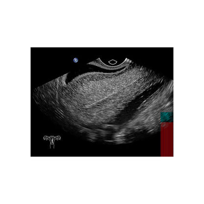 Blue Phantom Transvaginal Ultrasound Training Model