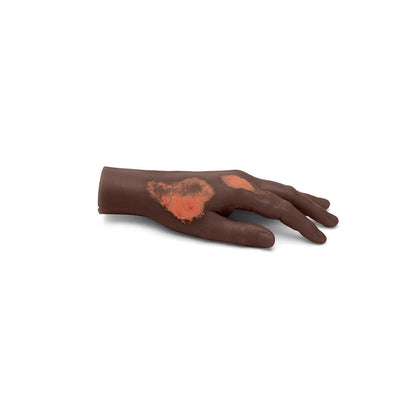 Medicor Small Adult Burned Hand