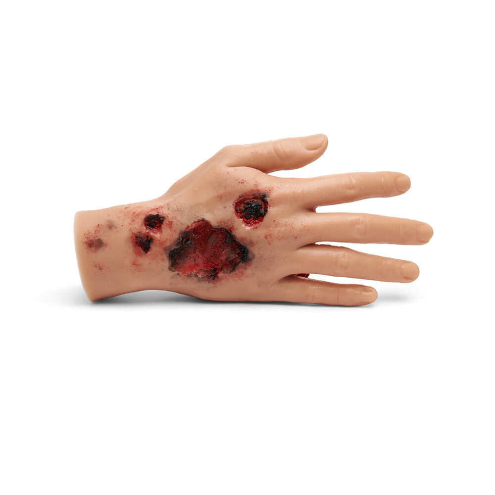 Medicor Large Adult Burned Hand