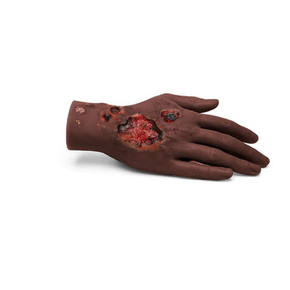 Medicor Large Adult Burned Hand