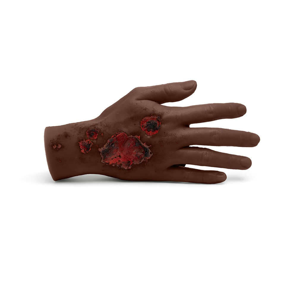 Medicor Large Adult Burned Hand