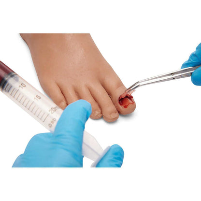 Medicor Toenail Removal