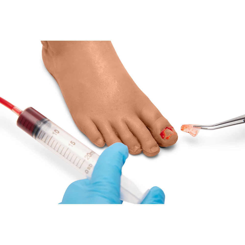 Medicor Toenail Removal