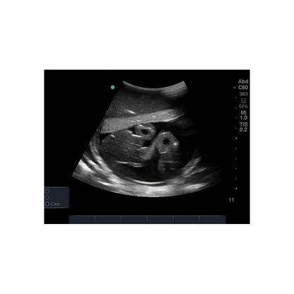 Blue Phantom Amniocentesis Ultrasound Training Model