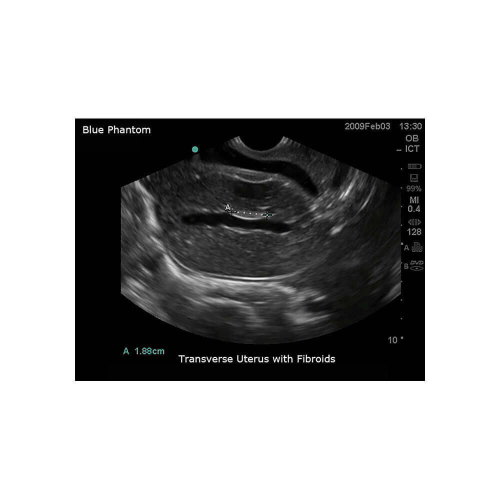 Blue Phantom Transvaginal Ultrasound Training Model