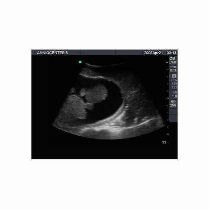 Blue Phantom Amniocentesis Ultrasound Training Model