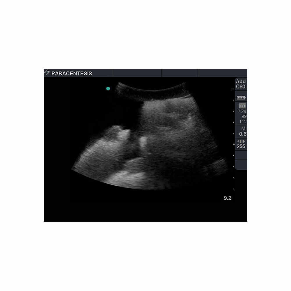 Blue Phantom Paracentesis Ultrasound Training Model