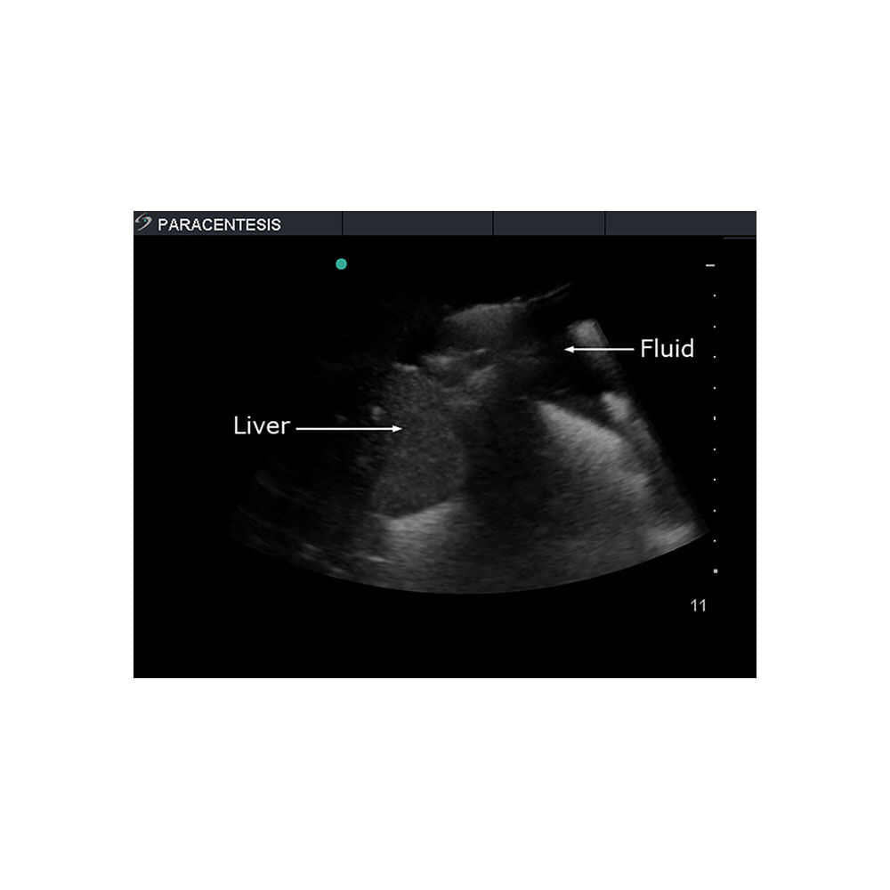 Blue Phantom Paracentesis Ultrasound Training Model