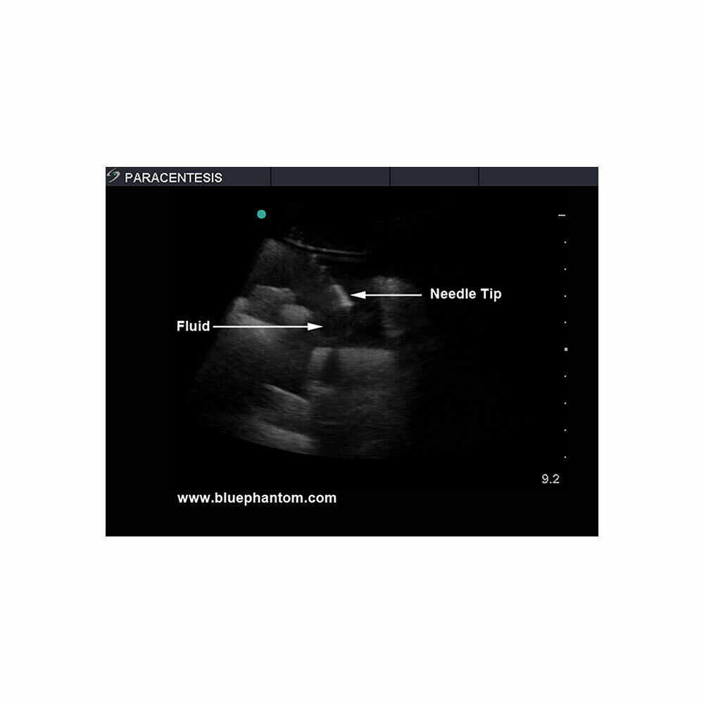 Blue Phantom Paracentesis Ultrasound Training Model