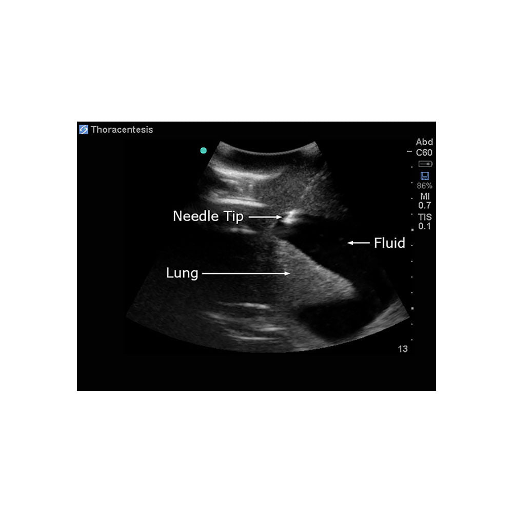 Blue Phantom Thoracentesis and Thoracostomy Ultrasound Training Model