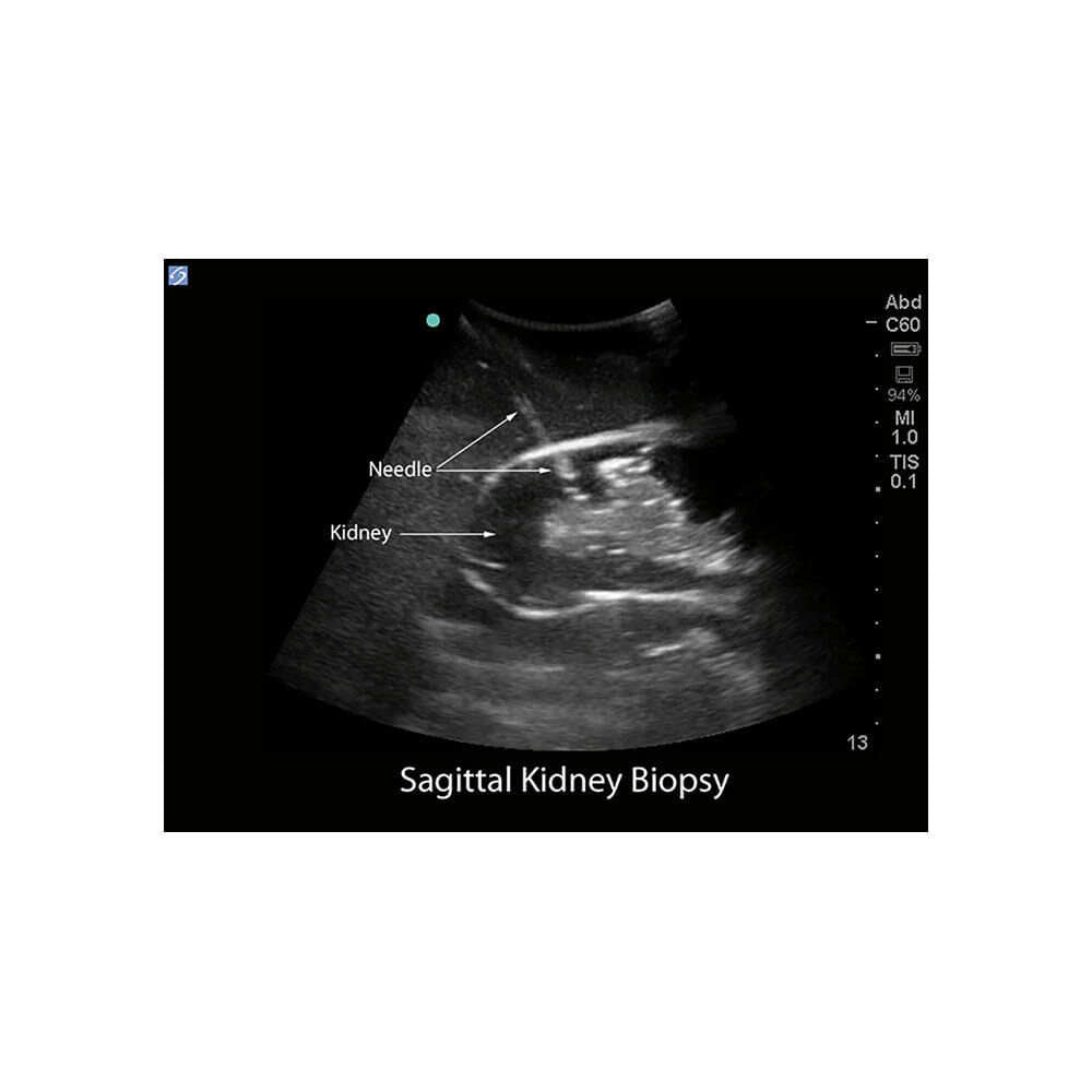 Blue Phantom Renal Biopsy Ultrasound Training Model